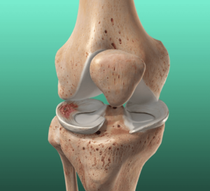meniscus revalidatie